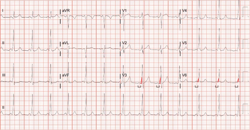 Antidromic Atrioventricular Reentrant Tachycardia