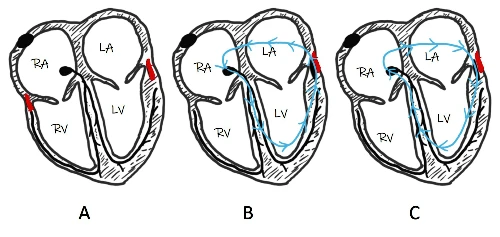 Antidromic Atrioventricular Reentrant Tachycardia