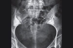 Osteitis condensans ilii X-ray Feature Image