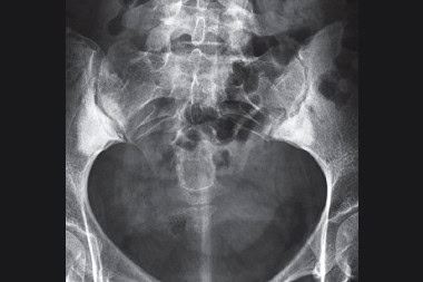 30-Year-Old With Back Pain