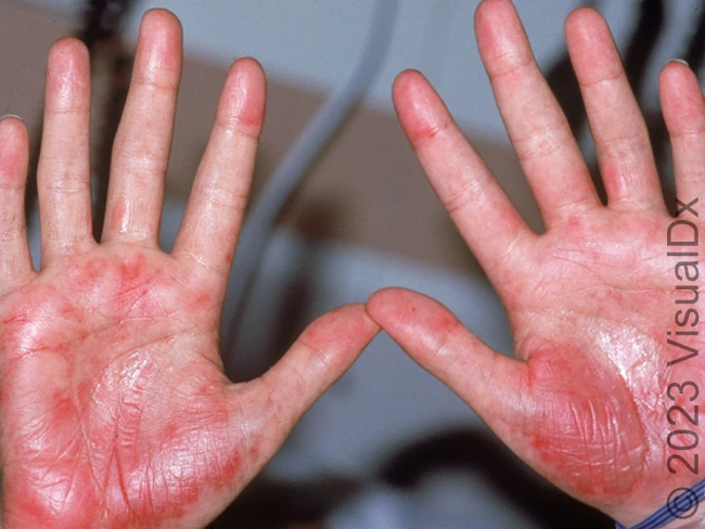 toxic erythema of chemotherapy 