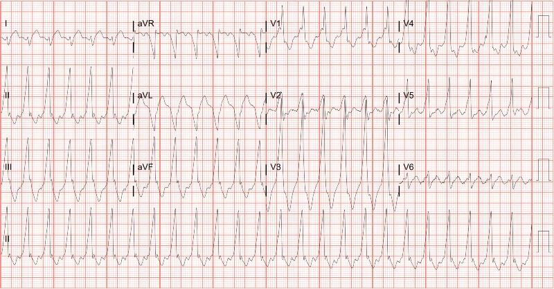 Antidromic Atrioventricular Reentrant Tachycardia