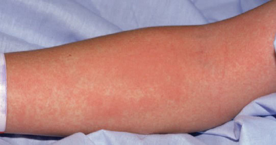 Toxic Shock Syndrome Rash