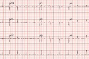 Persistent juvenile T-wave pattern (PJTWP)