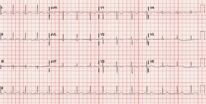 PJTWP ECG