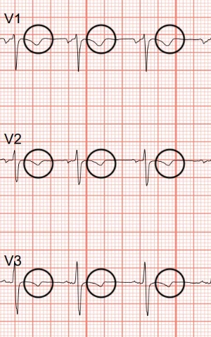 PJTWP ECG with T-waves Circled