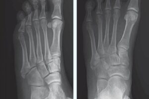 Avulsion Fracture of the 5th metatarsal