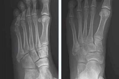 29-Year-Old With Pain After Foot Inversion