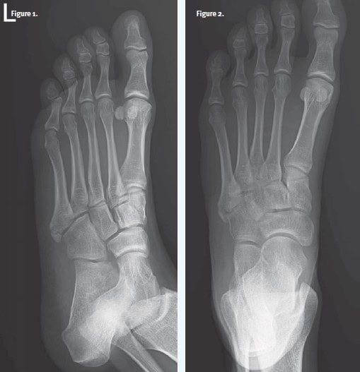 Avulsion Fracture 5th Metatarsal