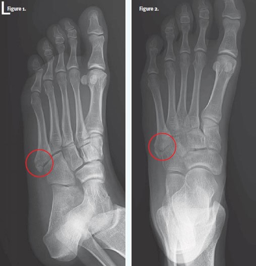 Avulsion Fracture 5th Metatarsal