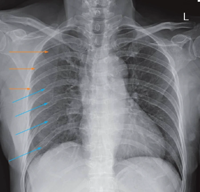 Rib Fracture in Urgent Care X-ray