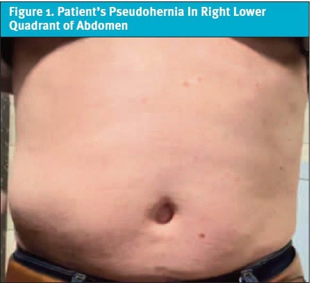 Pseudohernia in Right Lower Quadrant of Abdomen