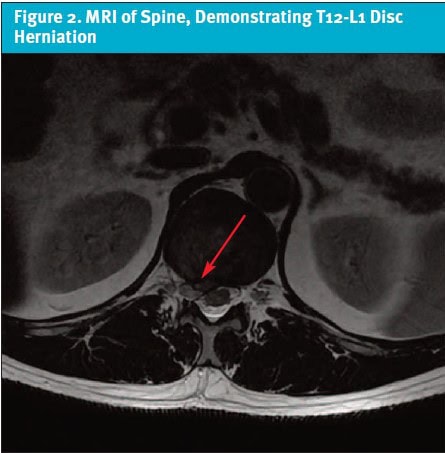 MRI of Spine, T12-L2 Disc Herniation, Abdominal Pseudohernia