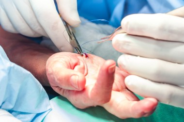 Laceration Repairs Decline in Urgent Care