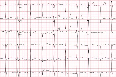 35-Year-Old With ESRD