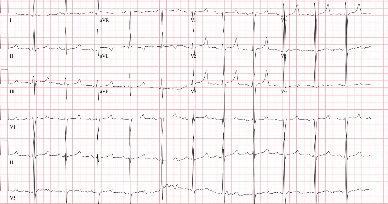 ESRD Patient ECG