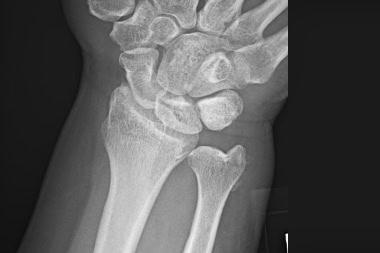 55-Year-Old With Wrist Pain