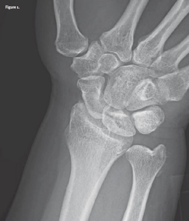 Acute Calcific Periarthritis 