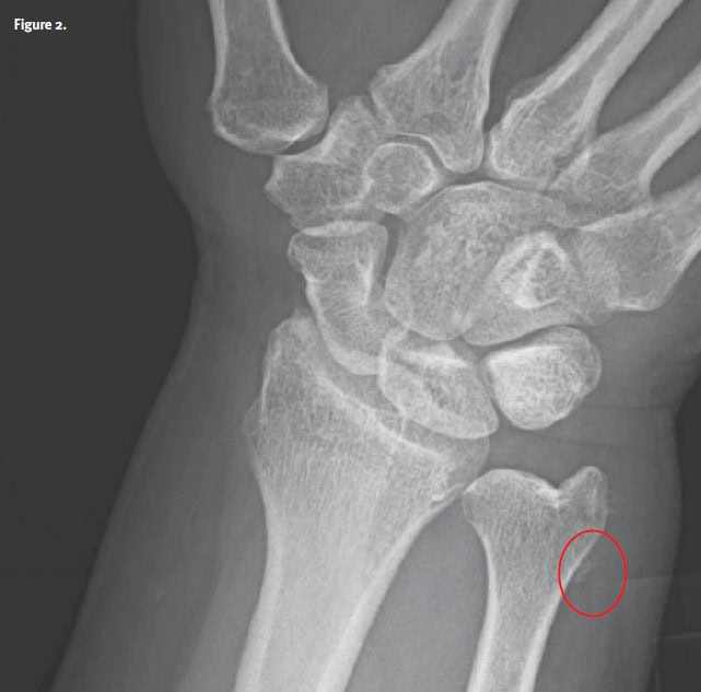 acute calcific periarthritis x-ray