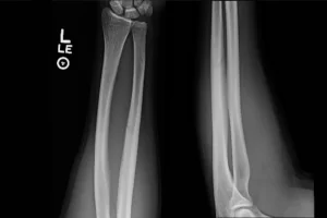 Urgent Care Diagnosis and Management of Midshaft Ulnar (Nightstick) Fractures