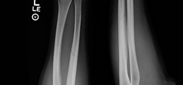 Urgent Care Diagnosis and Management of Midshaft Ulnar (Nightstick) Fractures