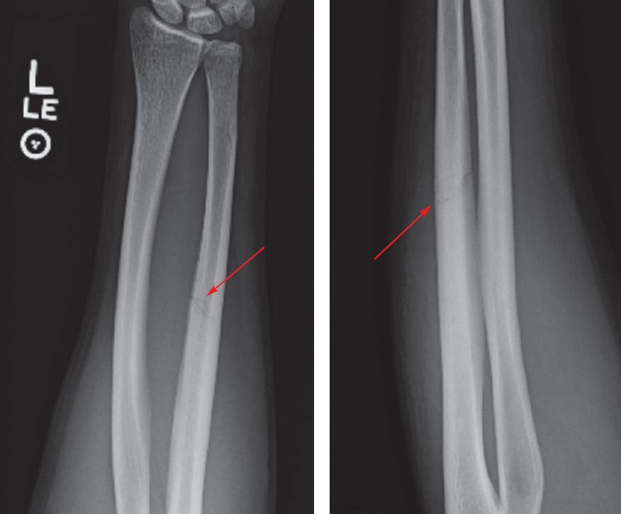 Urgent Care Diagnosis and Management of Midshaft Ulnar (Nightstick ...