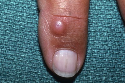 65-Year-Old With Finger Growth