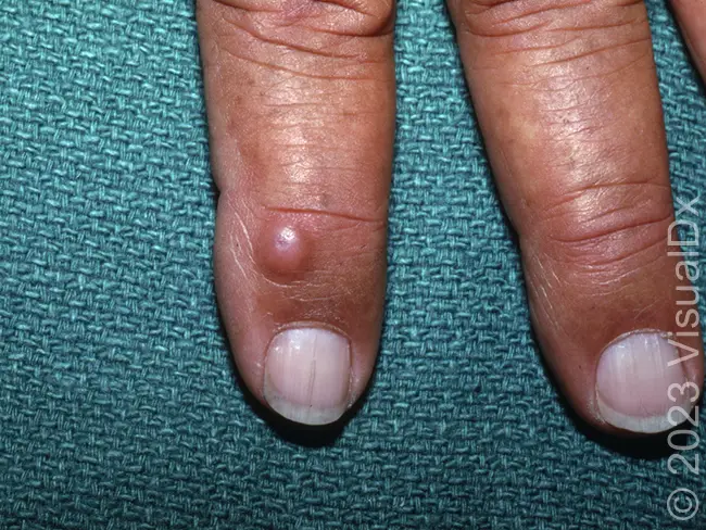 myxoid cyst finger growth