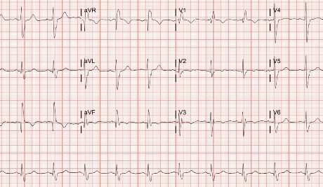 74-Year-Old With Lightheadedness