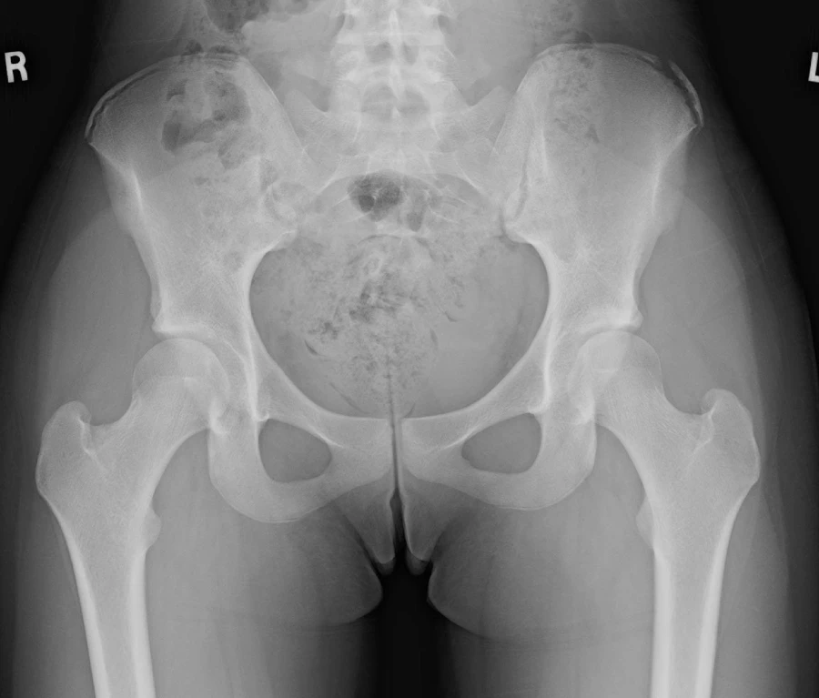 iliac crest apophysis avulsion fracture