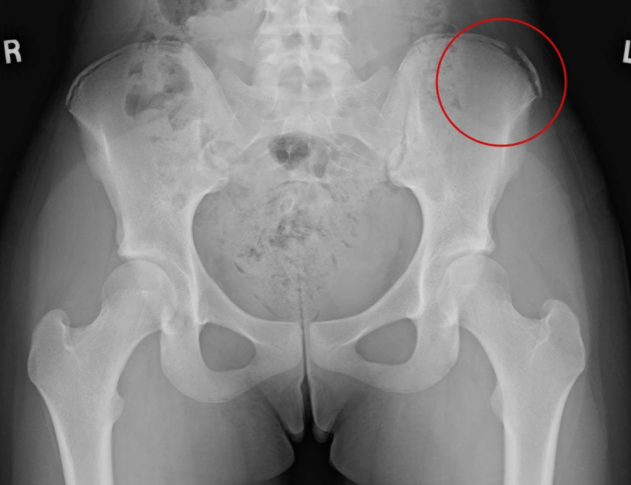 iliac crest apophysis avulsion fracture