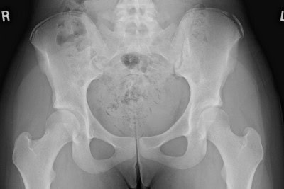 16-Year-Old With Hip Pain