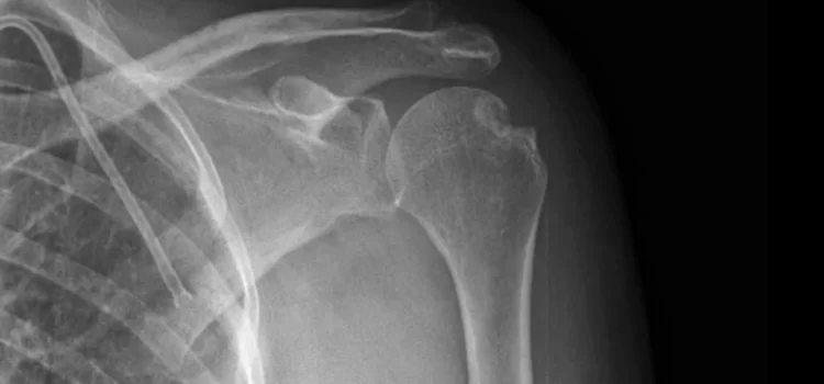 Urgent Care Assessment and Management of Shoulder Dislocations