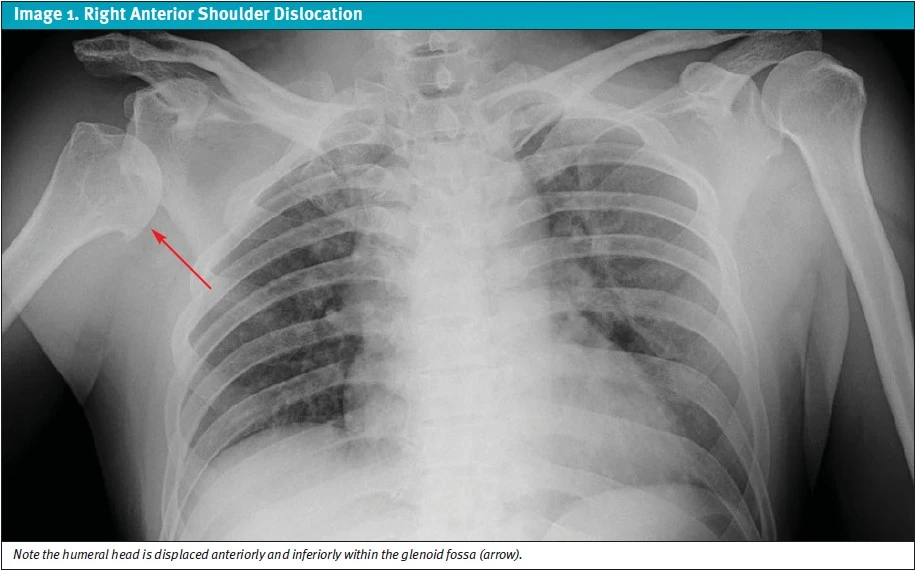 Right Anterior Shoulder Dislocations in Urgent Care X-ray