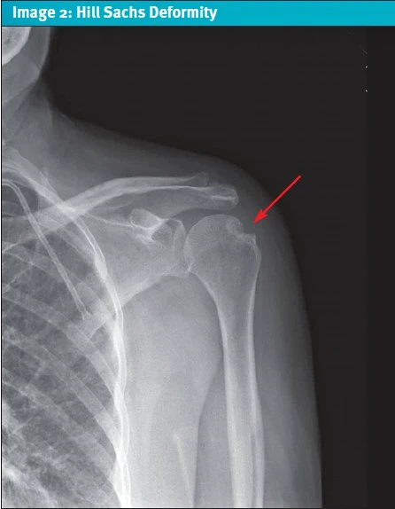 Hill Sachs Deformity X-ray