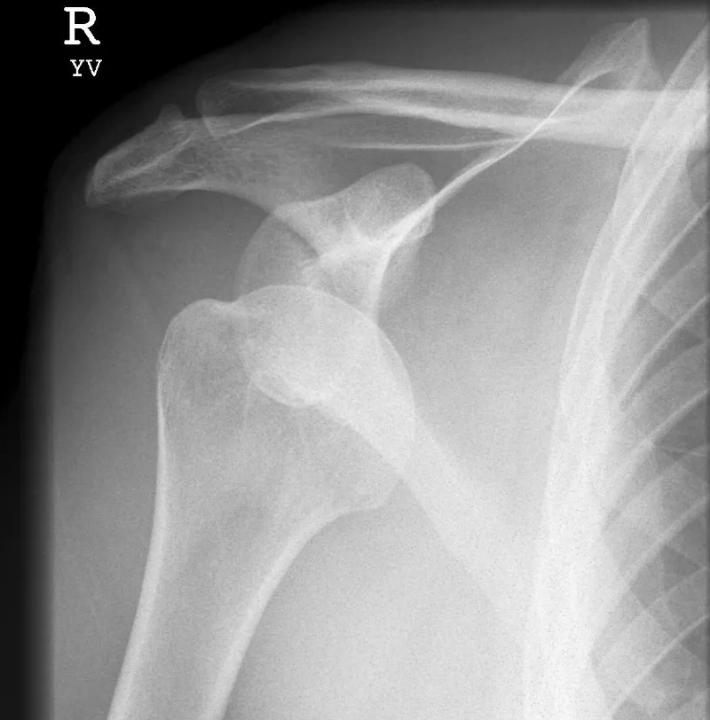 urgent care shoulder dislocation, X-ray of Patient with Anterior Dislocation On Transscapular Y View 