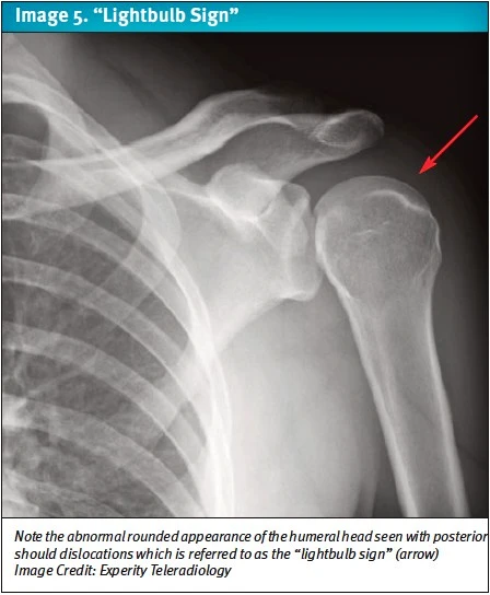 urgent care shoulder dislocation, X-ray image showing the lightbulb sign