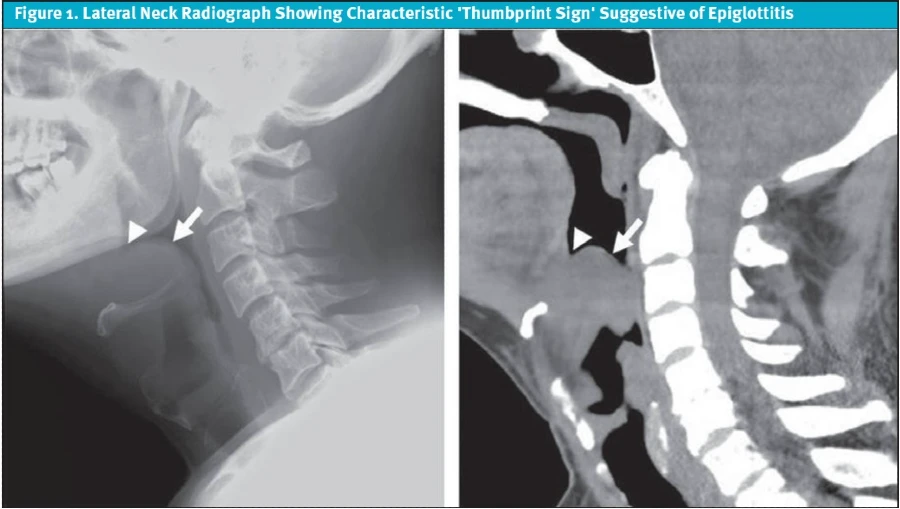 Figure 1. Lateral Neck Radiograph Showing Characteristic 'Thumbprint Sign' Suggestive of Epiglottitis, Epiglottitis Patient Death