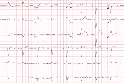 68-Year-Old With Dyspnea