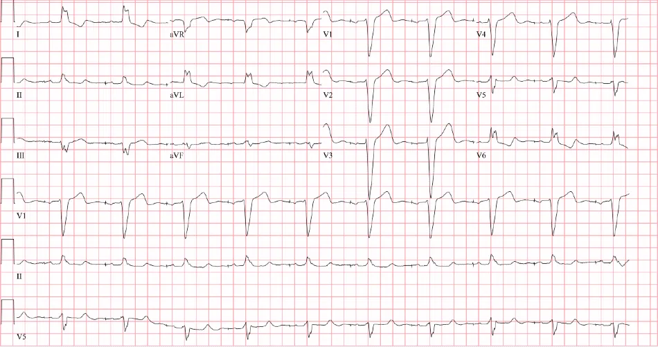 68-Year-Old With Dyspnea