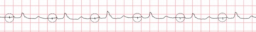 68-Year-Old With Dyspnea