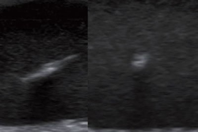 57-Year-Old with Left Foot Pain