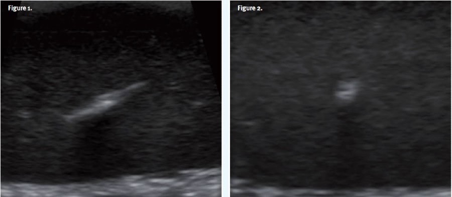 POCUS of Wooden Foreign Body