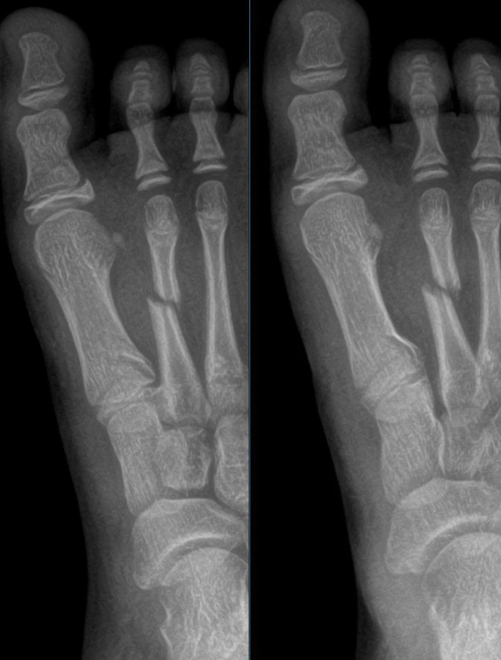 Fractures of the First and Second Metatarsals