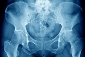 Hip Osteoarthritis in Urgent Care