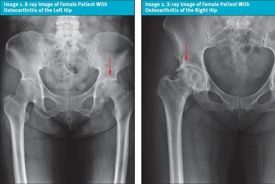 Hip Osteoarthritis in Urgent Care