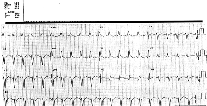 A 45-Year-Old Woman with Acute Chest Pain