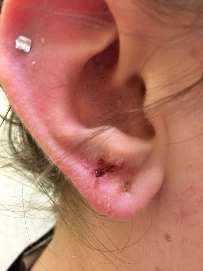 infected ear cartilage piercing