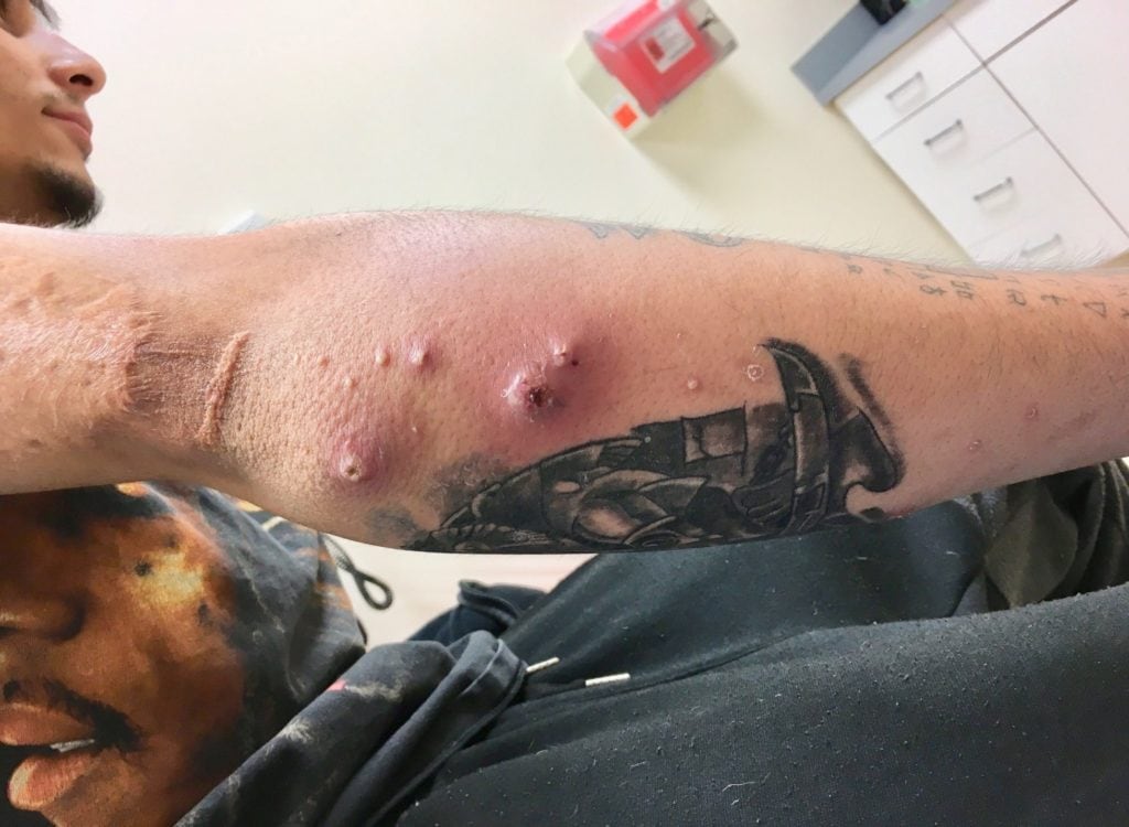 Infected Tattoo Stages Signs of Infection from Tattoos and After Tattoo  Removal  Removery