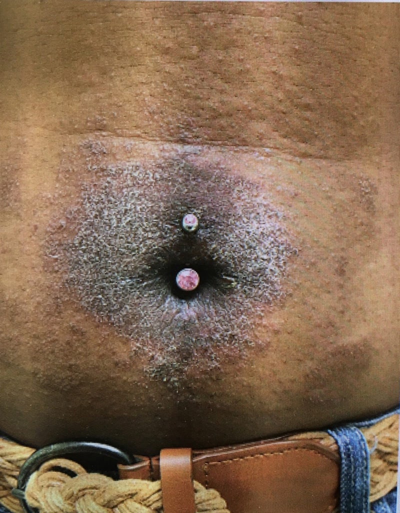 Belly button piercing: infections, rejections, pain and how long it takes  to heal